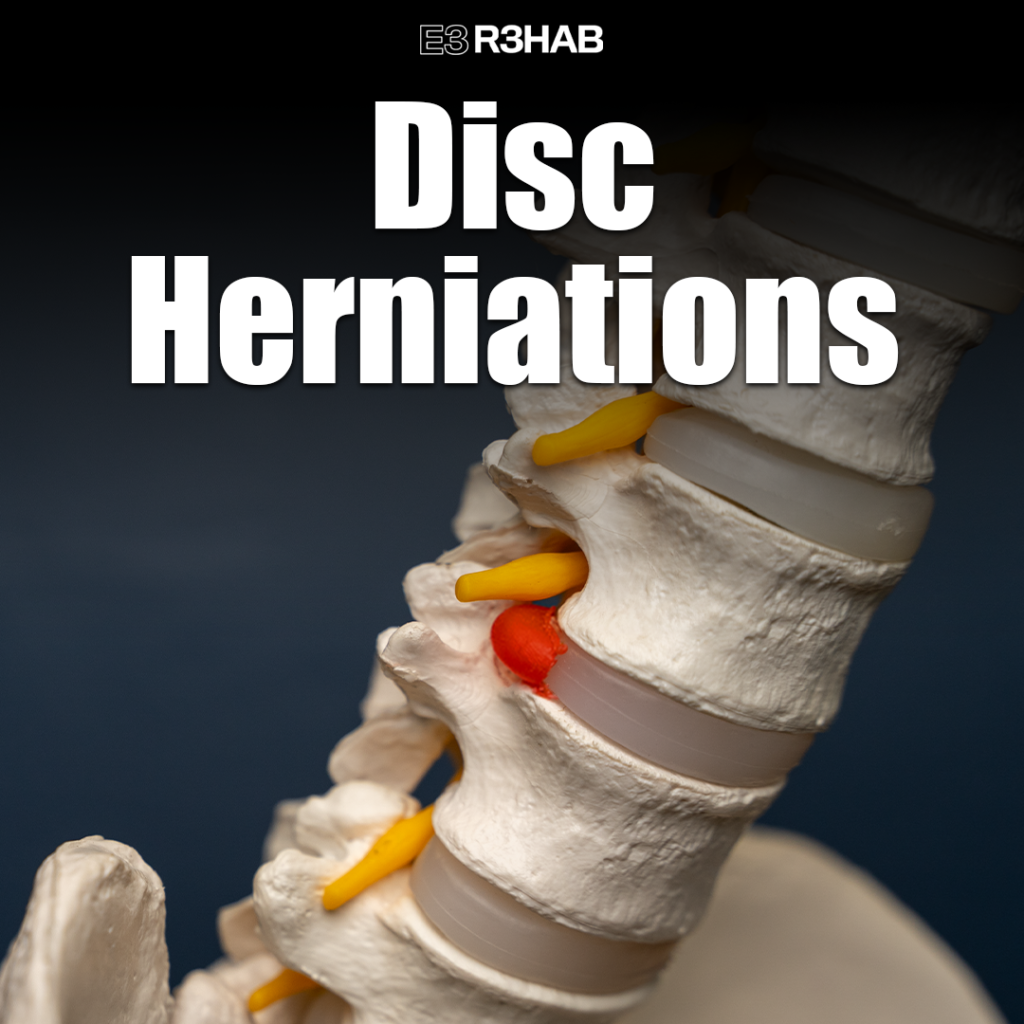 Disc Herniations E3 Rehab