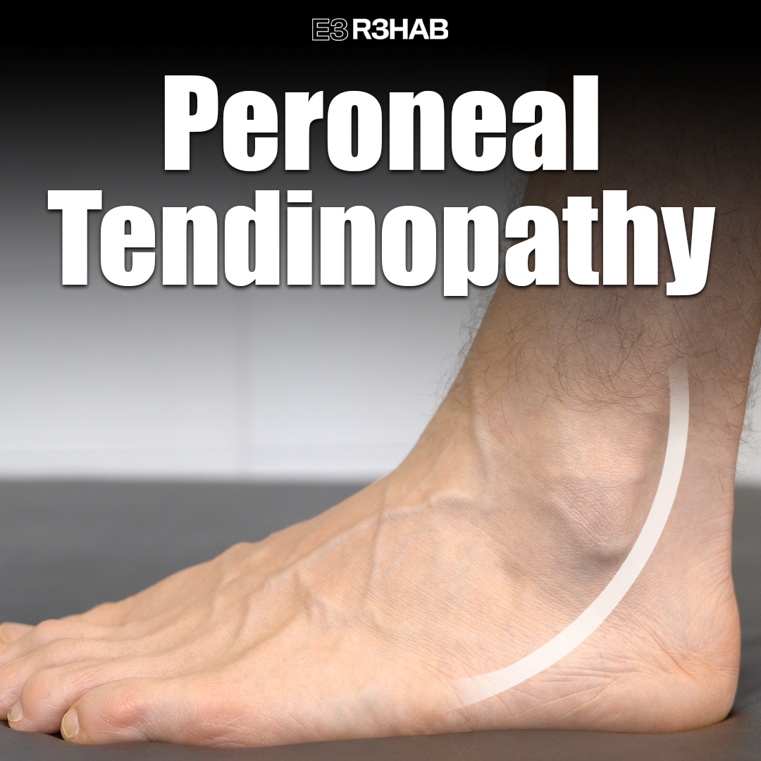 Peroneal Tendinopathy E Rehab