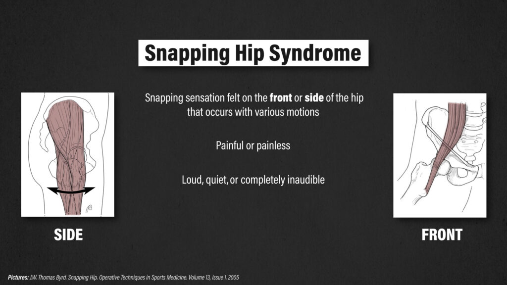 Snapping Hip Syndrome