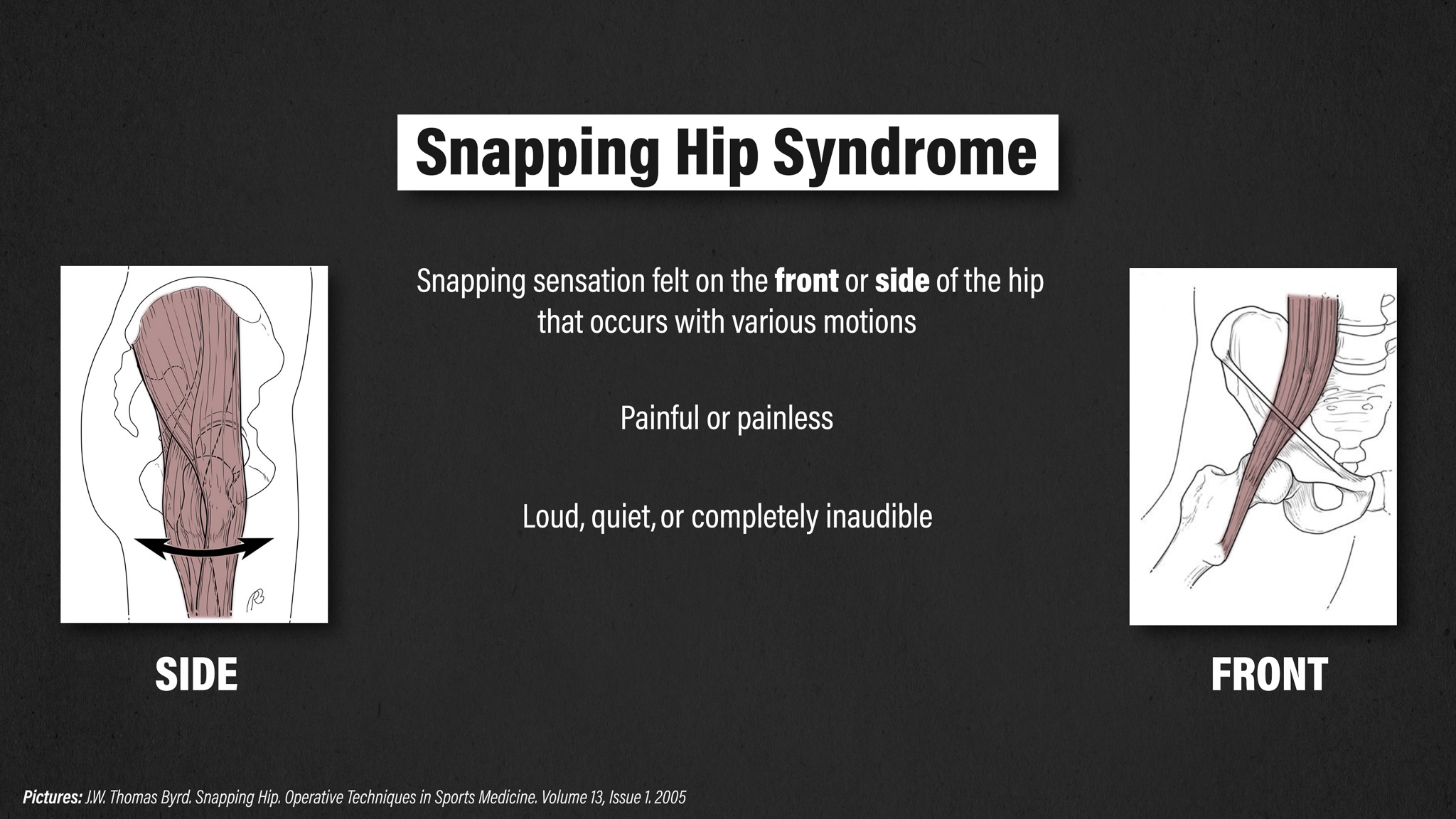 Snapping Hip Syndrome E3 Rehab