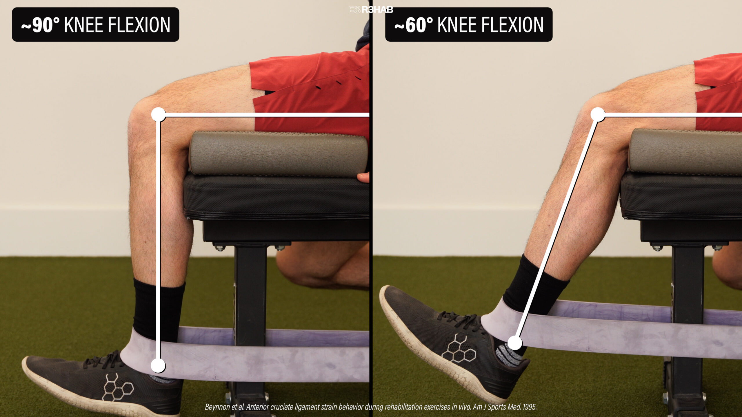 Swelling and flexion contracture of the right knee of a | Open-i