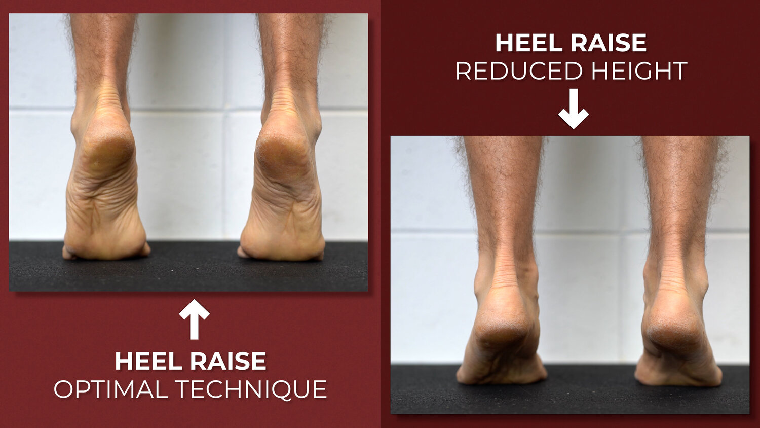 Tibialis Posterior Tendinopathy E3 Rehab