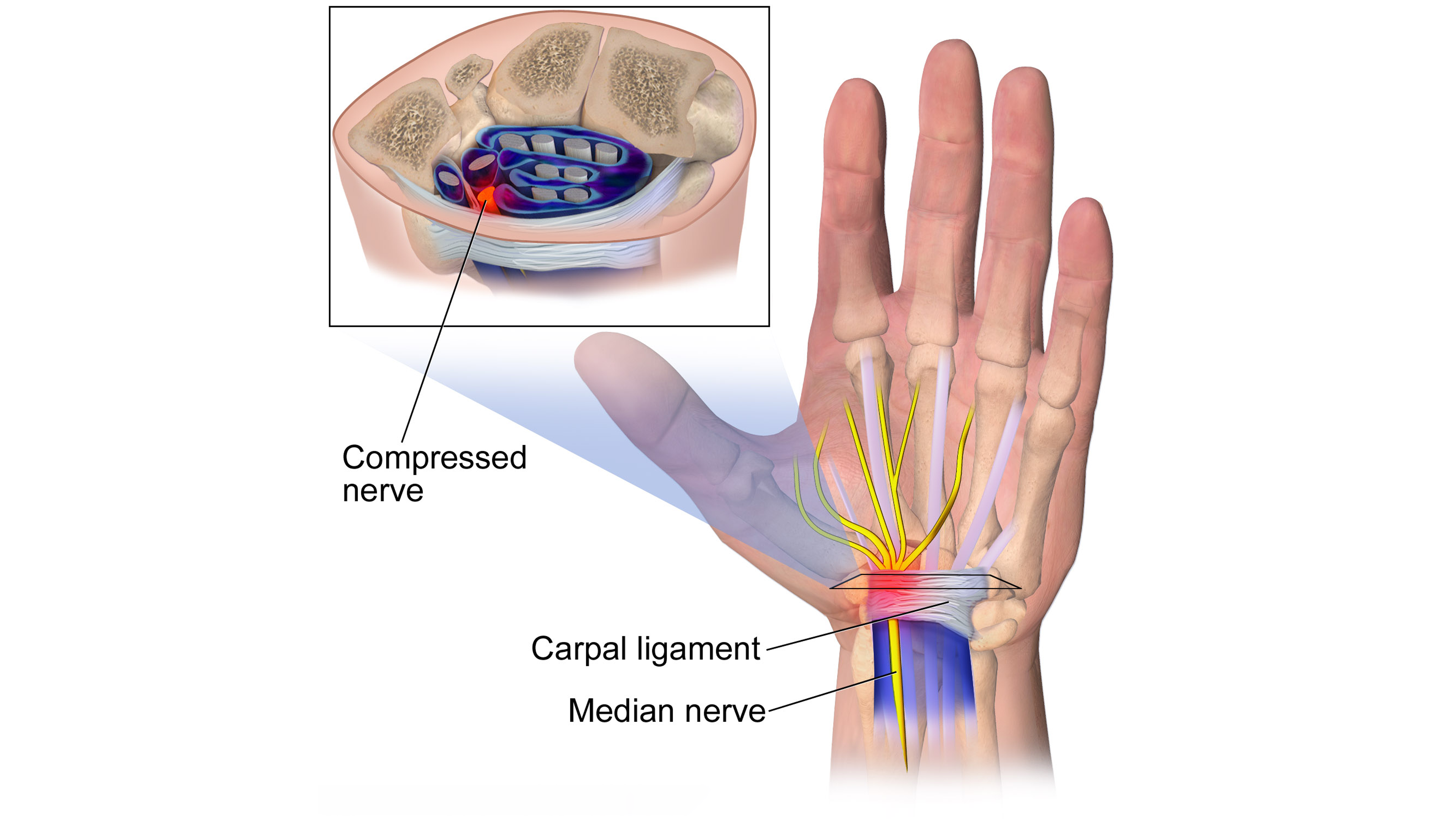 How to Relieve Carpal Tunnel Pain in SECONDS 